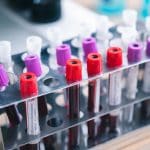 What does my blood test mean? A simple guide to basic lab results Blood test samples (licensed content)